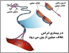 نشانه های هشدار دهنده "ام اس" رابدانید