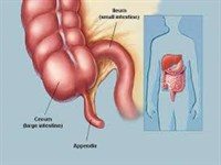 آپاندیس عمل کرده‌ها بخوانند